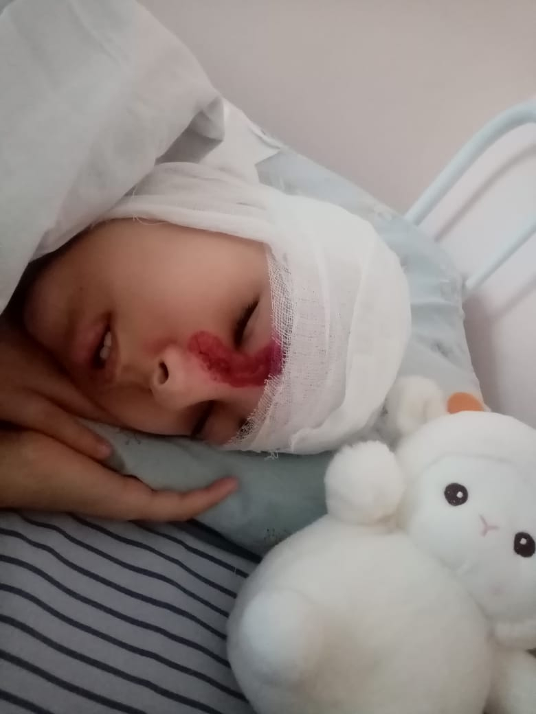 Зухра живёт с открытым черепом!